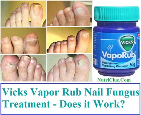 Can Vicks Vapor Rub Cure Toenail Fungus Namibiauraniuminstitute Com