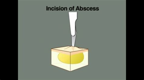 Abcess Incision And Drainage Nejm Youtube