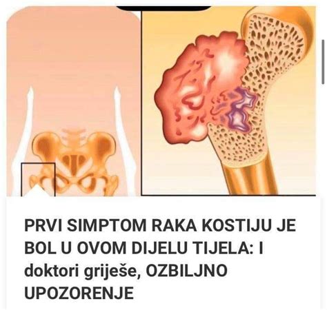 Pogledajte Koji Su To Prvi Simptomi Raka Kostiju Balkan Story