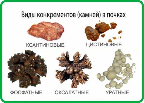 Камни мочеточника диета микролиты почек код по мкб 10 у взрослых микролиты почек код по мкб 10 у взрослых Камни мочеточника диета