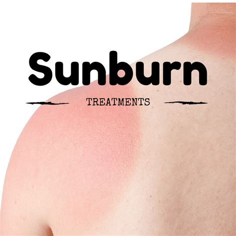 Sunburn Treatment Soothing A Burn — Thrifty Mommas Tips