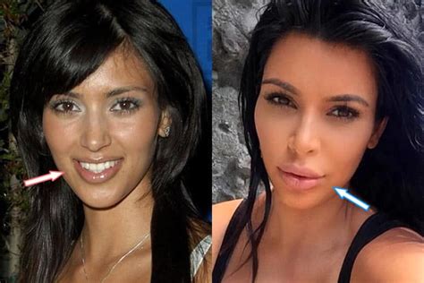 kim kardashian plastic surgery before after pictures