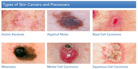 If you have skin cancer, the doctor will want to find out how far it has spread. CAPELLA blog post featuring Dr. Munavalli | Dermatology ...