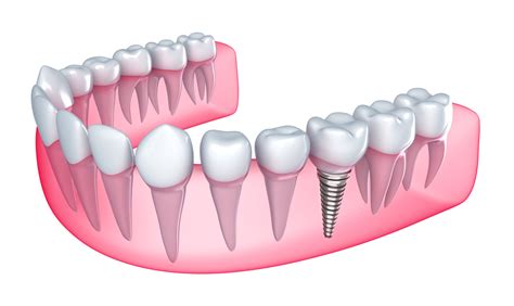 What Is A Single Tooth Implant — Dfw Implant Team ┃ Donald Steinberg Dds