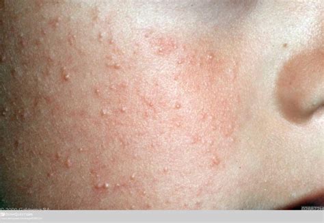 Winter Is Coming A Dermatologists Tips For Managing Keratosis Pilaris
