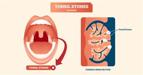 How To Differentiate Between Tonsil Stones And Tonsil Cancer Human