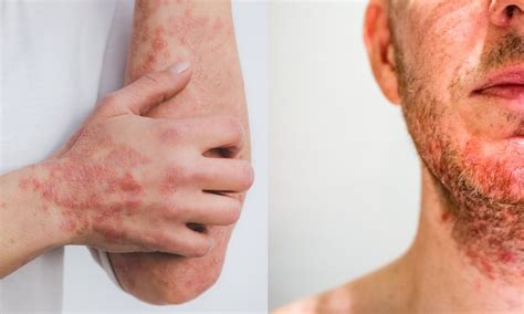 Seborrheic Dermatitis Vs Psoriasis Differences Symptoms Causes