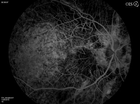 Wet Age Related Macular Degeneration With Angioid Streaks And