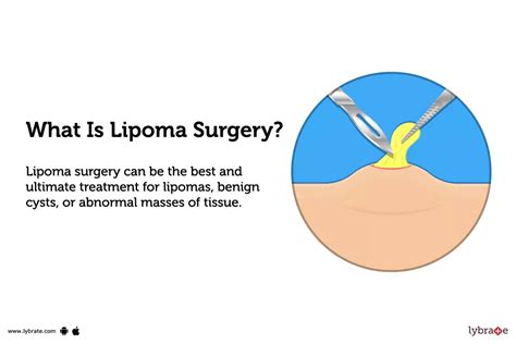 Lipoma Surgery Purpose Procedure Benefits And Side Effects