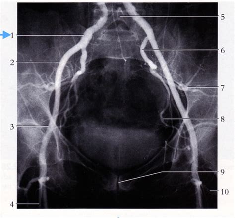 Atlas Fig 1223 Angiogram Of Common Iliac Arteries And Branches