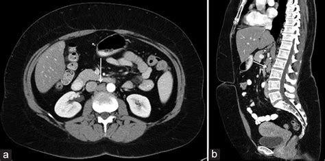 Transdiscal Core Biopsy Of Aortocaval Lymph Node A Case Report
