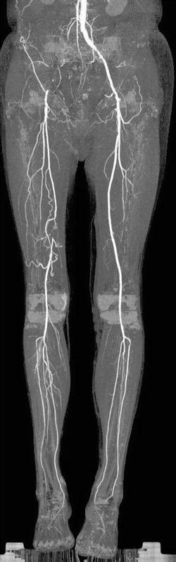 Venous Interventions From Lower Limb Deep Vein Thrombosis To May