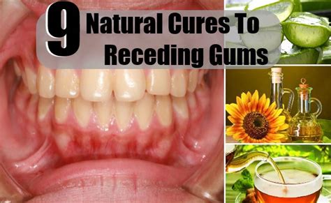 Best 9 Natural Cures To Receding Gums How To Cure Receding Gums
