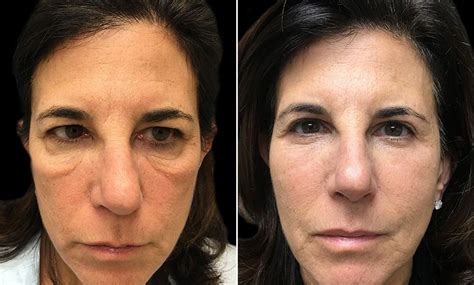 Festoon Surgery Before And After Image Puffy Eye Treatment Under Eye