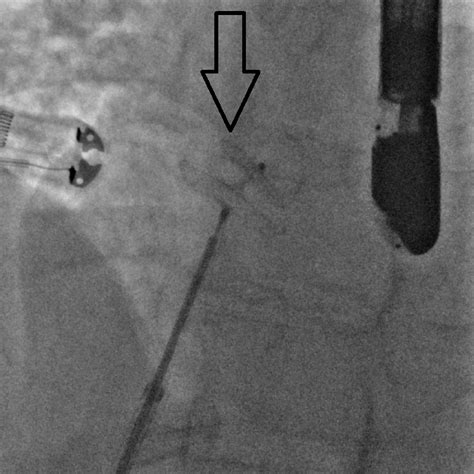 Figure 1 From Unplanned Removal Of A Patent Foramen Ovale Closure