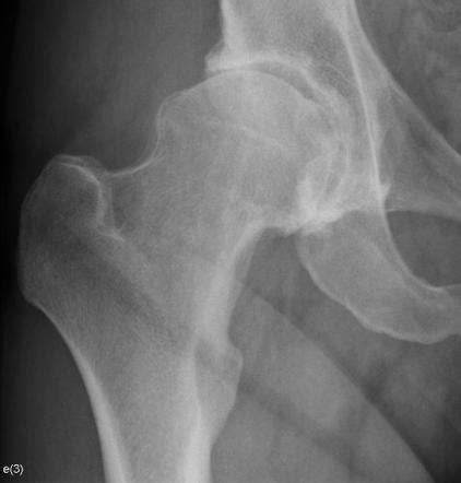 Osteoarthritis Of The Hip Radiology Reference Article Radiopaedia Org