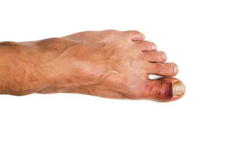 Broken Toe Stock Photos Pictures And Royalty Free Images Istock