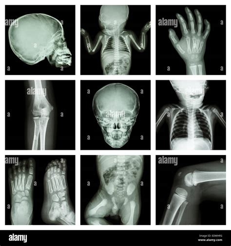 Collection X Ray Part Of Child Body Version 2 Stock Photo Alamy