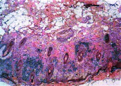 Histopathology Of Localized Classical Dle Showing The Typical