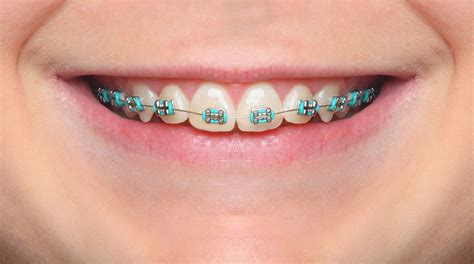 Colored Braces And Bands Murray Orthodontics