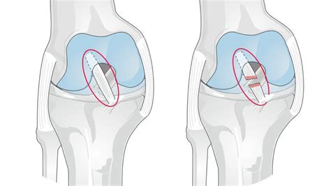 Acl Reconstruction Surgery Is A Second Hit To The Cartilage Time To