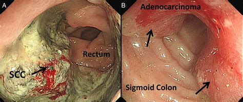 Synchronous Anal Squamous Carcinoma And Sigmoid Adenocarcinoma Bmj