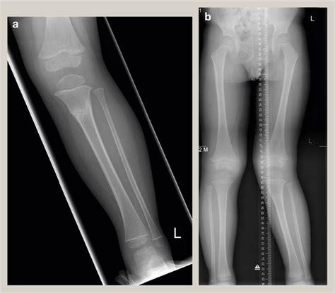 Common Paediatric Lower Limb Injuries Surgery Oxford International