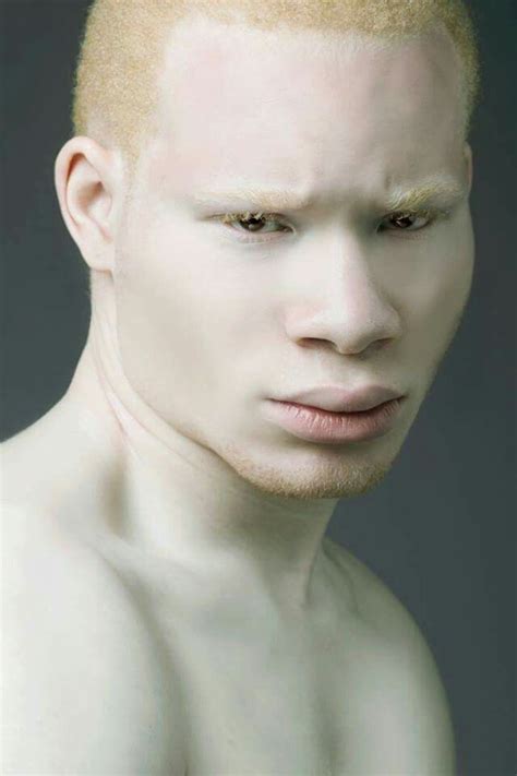 Albinism Albino Model Albinism Albino Human