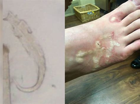Teen Infected With Hookworms On Florida Beach Wfts Tv