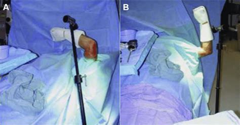 Our Preferred Patient Positioning For Elbow Arthroscopy Supine With A Download Scientific