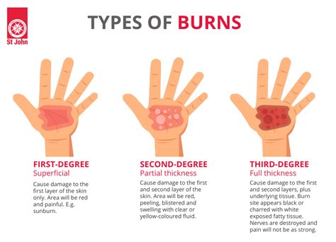 How To Treat And Recognise A Burn Effective First Aid For Burns
