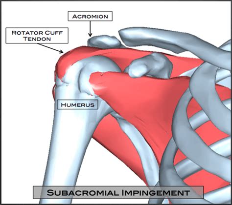 Subacromial Impingement Austin Tx Shoulder Impingement Round Rock