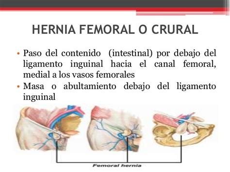 Hernia Femoral O Crural