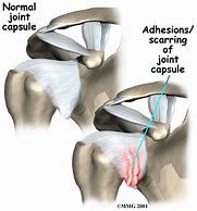 Image result for adhesive capsulitis