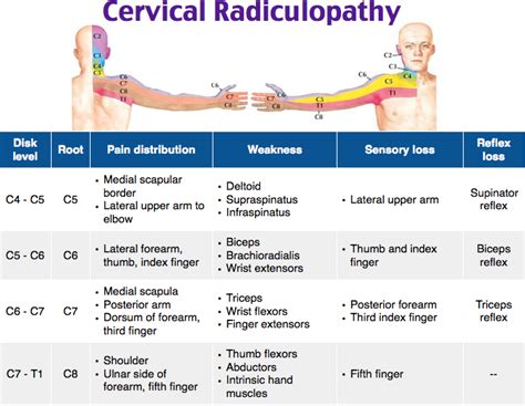 Cervical Radiculopathy Cervical Radiculopathy Radiculopathy Medical