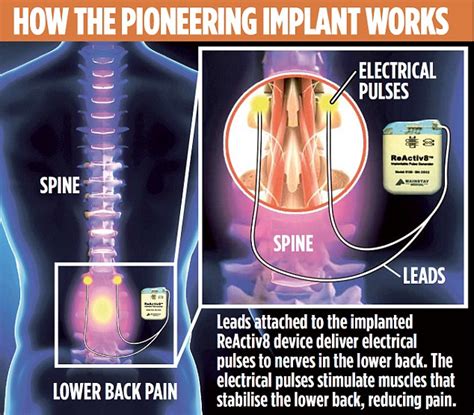 Remote Controlled Implant That Uses Electric Shocks To Wake Up Weak