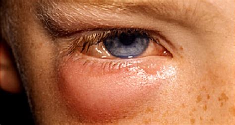 Cellulitis Under Eye
