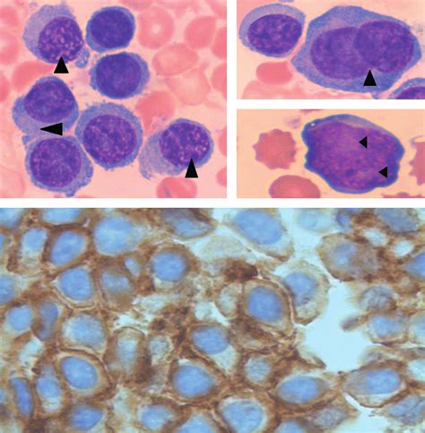 Bone Marrow Aspirate And Trephine Samples Of Primary Plasma Cell