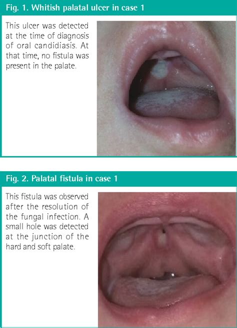 Figure 1 From Acquired Palatal Fistula In Patients With Submucous And