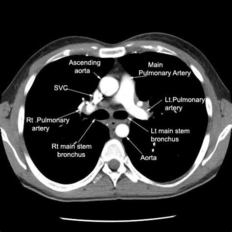 Pin By Verity Ramirez On Cardio Radiology Imaging