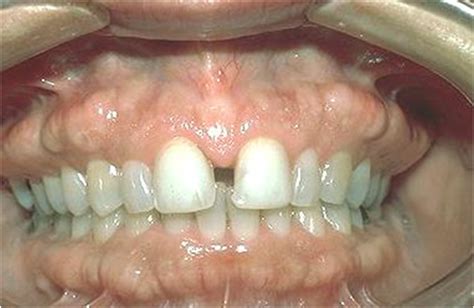 Healthy Ranula Notes On Developmental Defects Of The Oral And