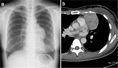Chest X Ray And Computed Tomography On Diagnosis Chest X Ray Showing A