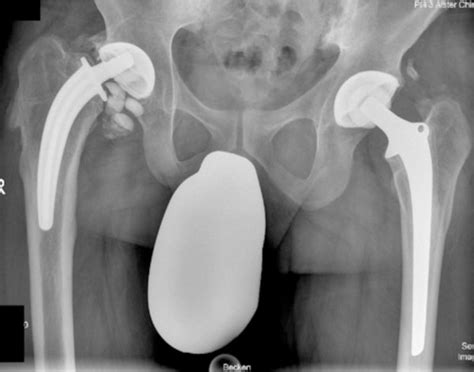 Traumatic Ceramic Femoral Head Fracture An Initial Misdiagnosis Fulltext