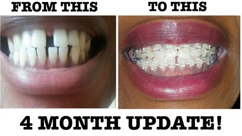 8 My Braces Journey 4 Month Braces Update Why Are They Moving So