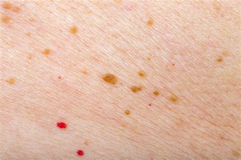 Tiny Red Blood Spots On Skin