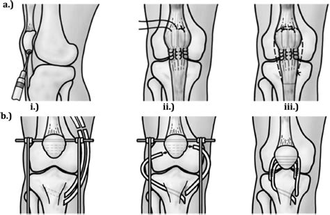 Reconstruction Techniques And Clinical Results Of Patellar Tendon