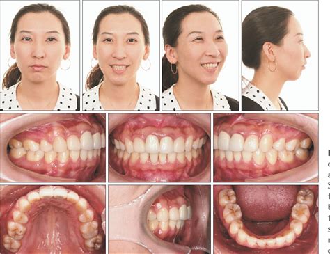 Figure 8 From Nonsurgical Correction Of A Severe Anterior Deep Overbite