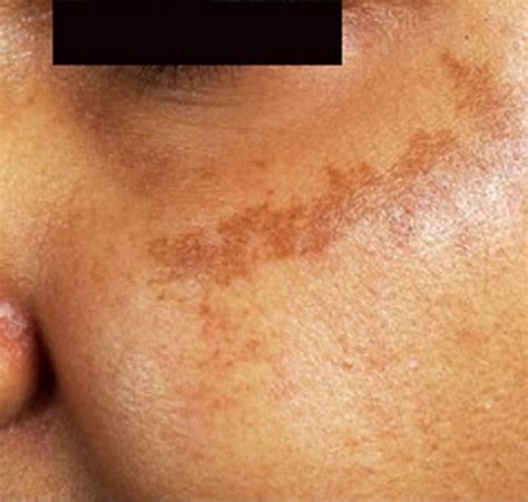 What causes patching of the skin ending up with lighter shades where the skin is actually a bit darker on the arms? brown spots appearing on skin - pictures, photos