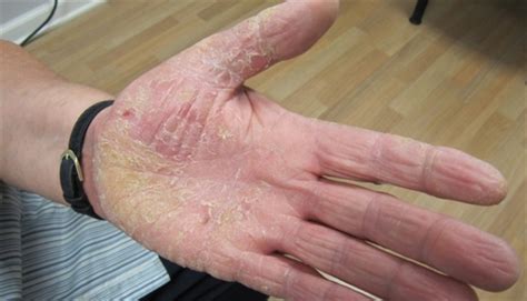 Scaling Rash On The Palms Clinical Advisor