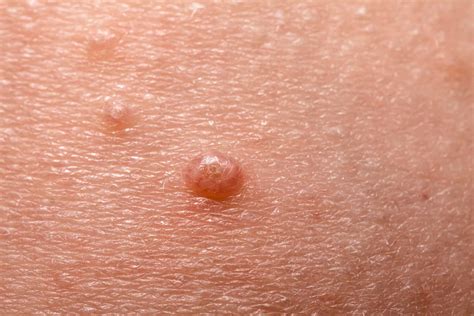Molluscum Contagiosum Skincentral Dermatology Aesthetics And Lasers